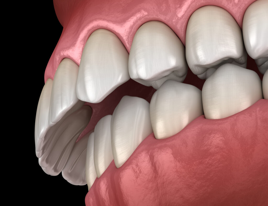 Different Bites That Could Be Affecting Your Oral Health - Park 56 Dental