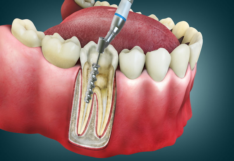Can a root canal last a lifetime?